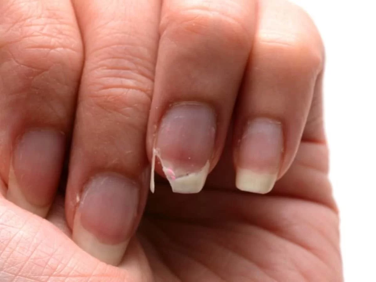 Calcium Deficiency