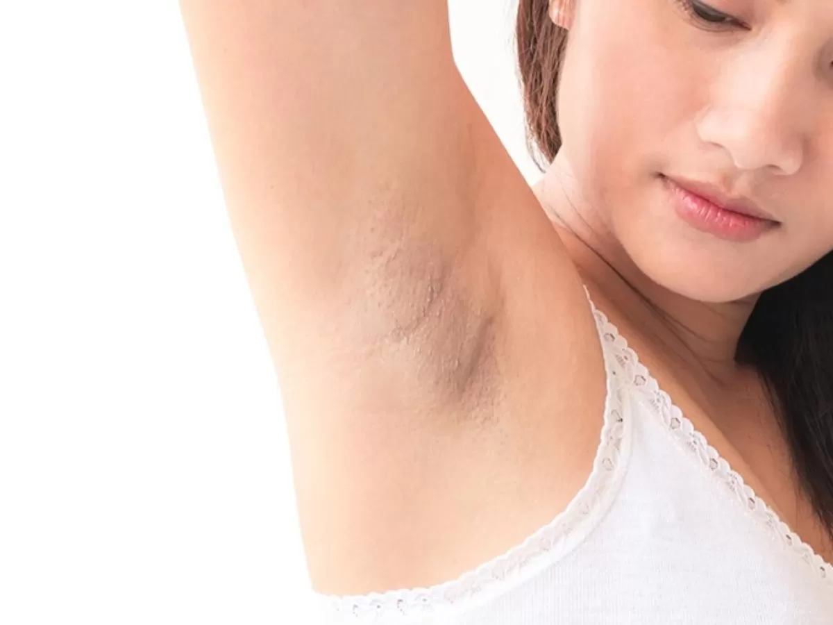 Dark Underarms Remedy