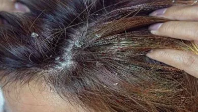 these home remedies can be effective for Get Rid Of Dandruff