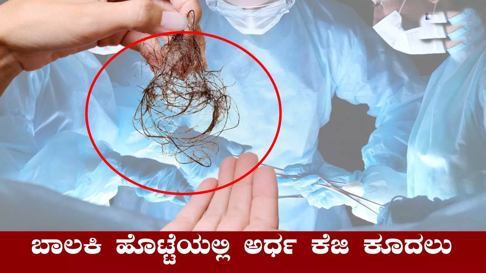 ಕೂದಲು ತಿನ್ನುವ ಅಭ್ಯಾಸ, ಬಾಲಕಿ ಹೊಟ್ಟೆಯಲ್ಲಿ ಅರ್ಧ ಕೆಜಿ ಕೂದಲು