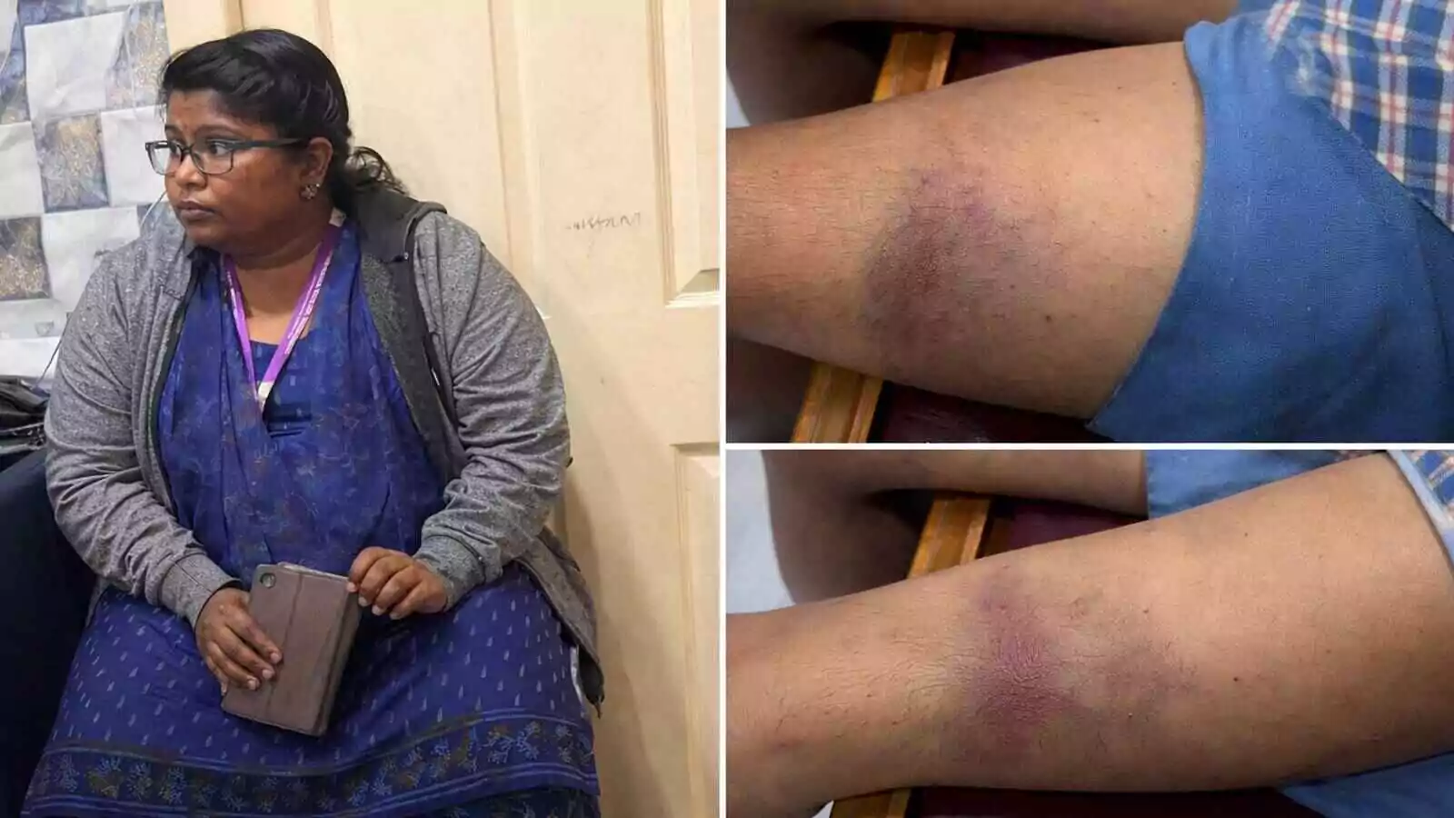 ಬೆಂಗಳೂರು ಖಾಸಗಿ ಶಾಲೆಯಲ್ಲಿ ಹೋಂವರ್ಕ್ ಮಾಡದ ಬಾಲಕನ ಮೇಲೆ ಶಿಕ್ಷಕಿಯಿಂದ ಹಲ್ಲೆ