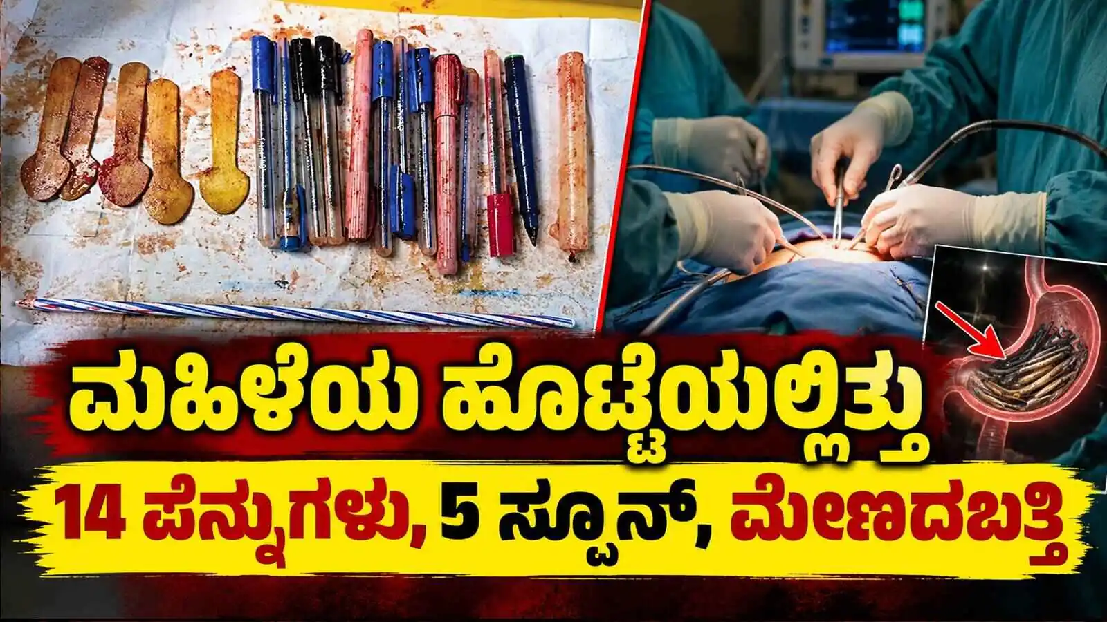 ಆಂಧ್ರಪ್ರದೇಶದ ಮಹಿಳೆಯ ಹೊಟ್ಟೆಯಿಂದ 14 ಪೆನ್ನುಗಳು, 5 ಸ್ಪೂನ್, ಮೇಣದಬತ್ತಿ ಹೊರತೆಗೆದ ವೈದ್ಯರು