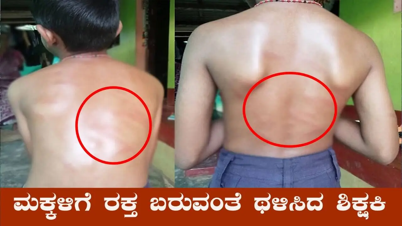 ಶಿವಮೊಗ್ಗ: ಪರೀಕ್ಷೆಯಲ್ಲಿ ಕಡಿಮೆ ಅಂಕ ಪಡೆದ 3 ಮಕ್ಕಳಿಗೆ ರಕ್ತ ಬರುವಂತೆ ಥಳಿಸಿದ ಶಿಕ್ಷಕಿ